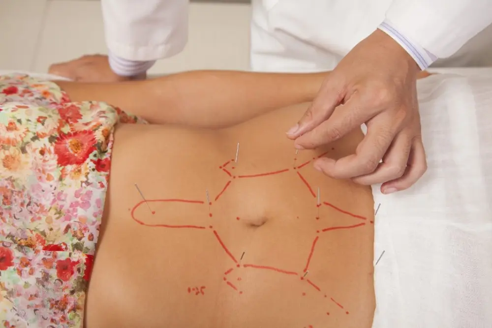 Acupuncture as a Holistic Approach to Weight Loss