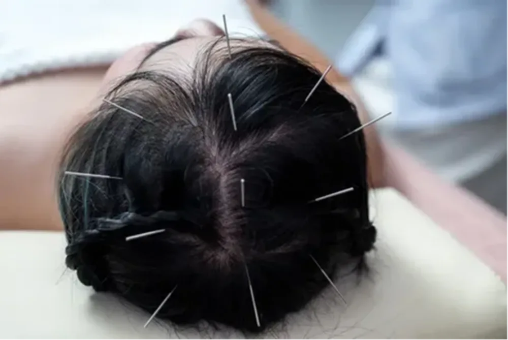 Investigating the Healing Power of Acupuncture on the Head