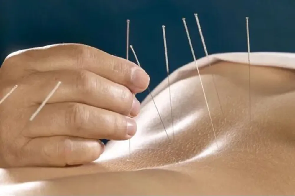acupuncture used for weight loss 