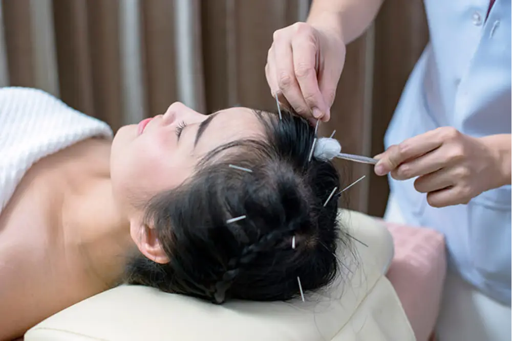 acupuncture on head benefits 