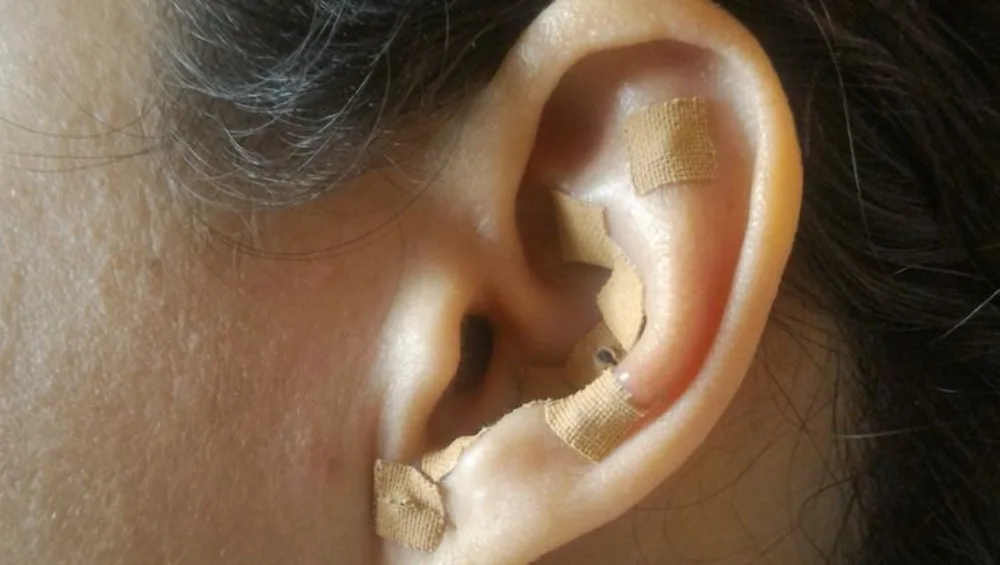 ear seeds for weight loss near me