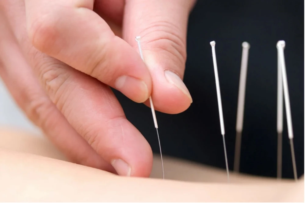 acupuncture and fertility benefits	