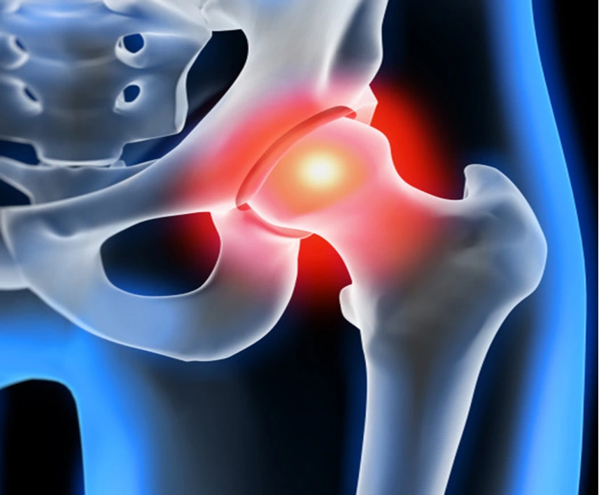 physiotherapy management of hip osteoarthritis 