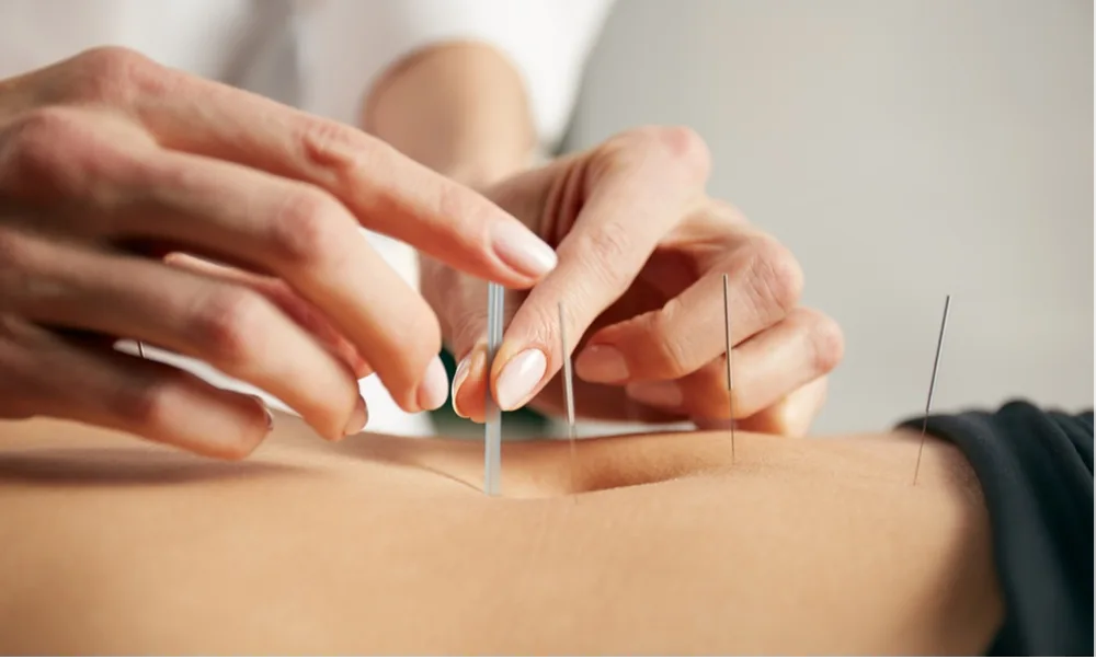 acupuncture cupping benefits