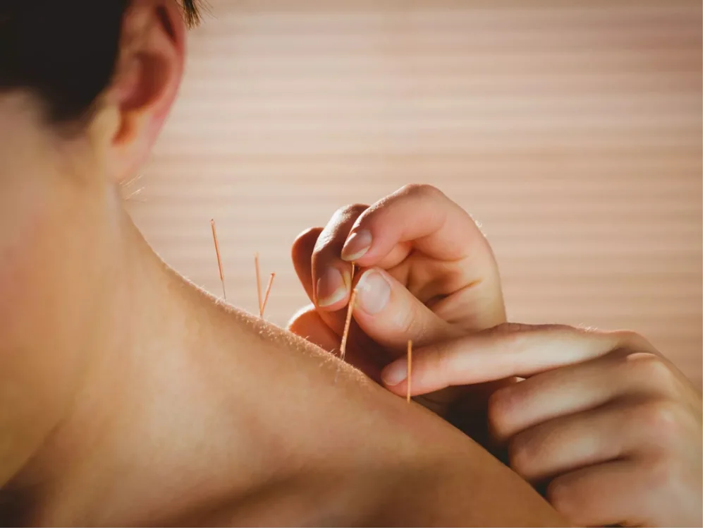 Exploring the Benefits of Acupuncture and Cupping Therapy