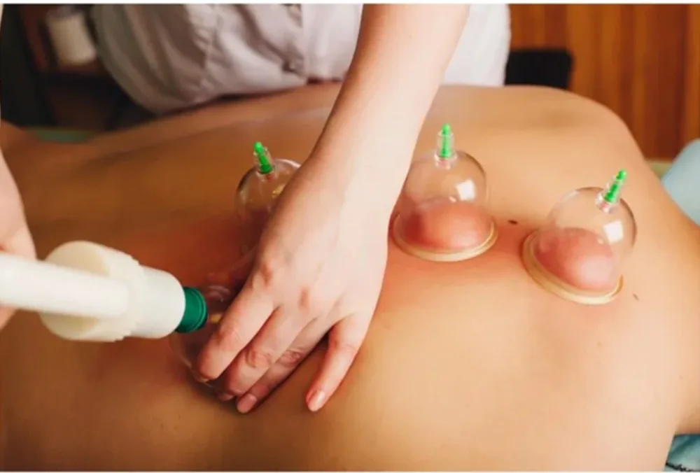 Acupuncture and Cupping Therapy Benefits