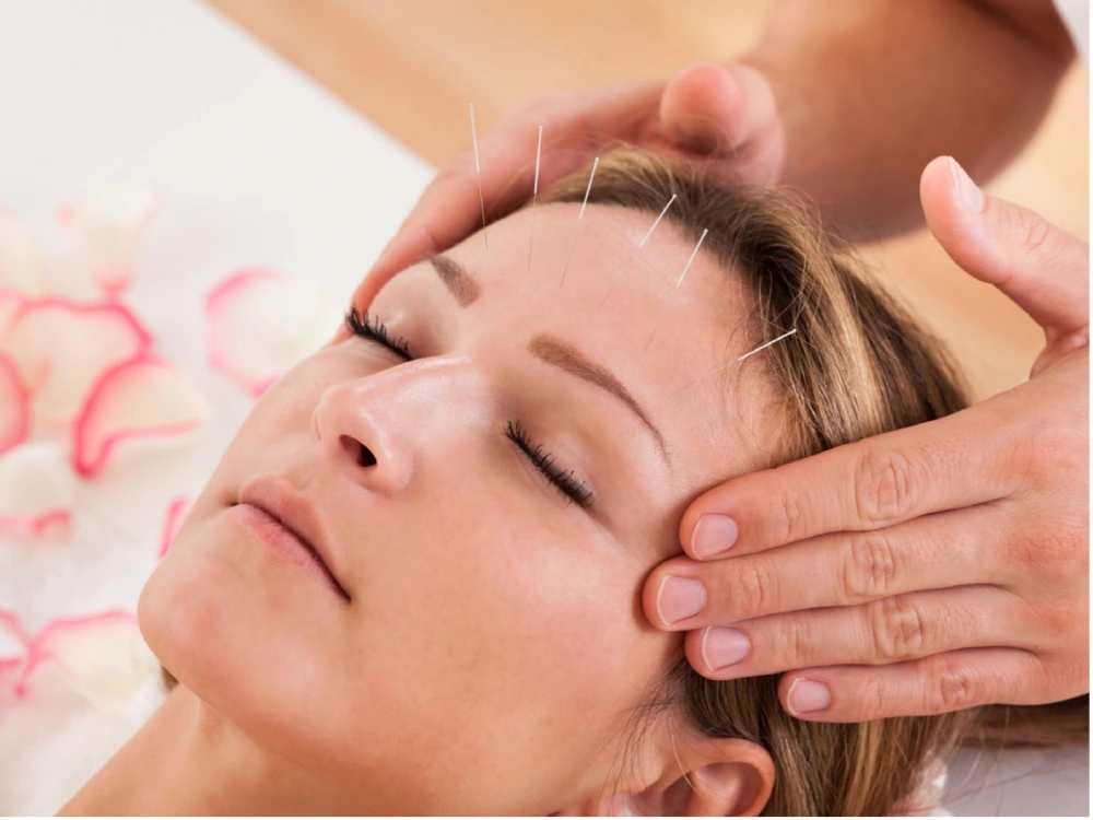 Acupuncture to reduce stress