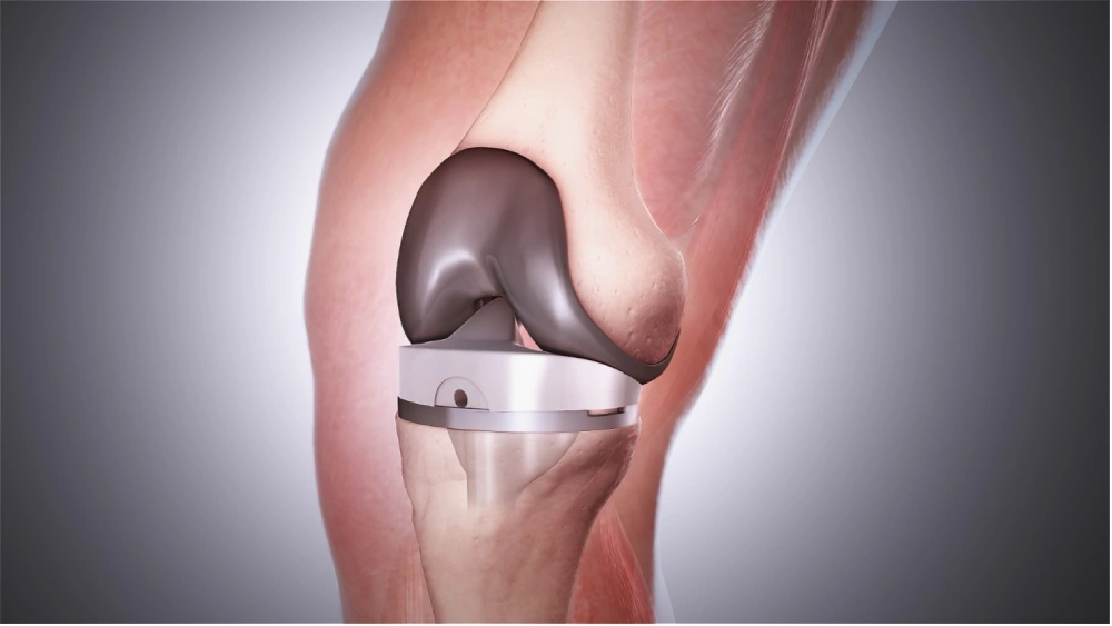 long term exercises after knee replacement