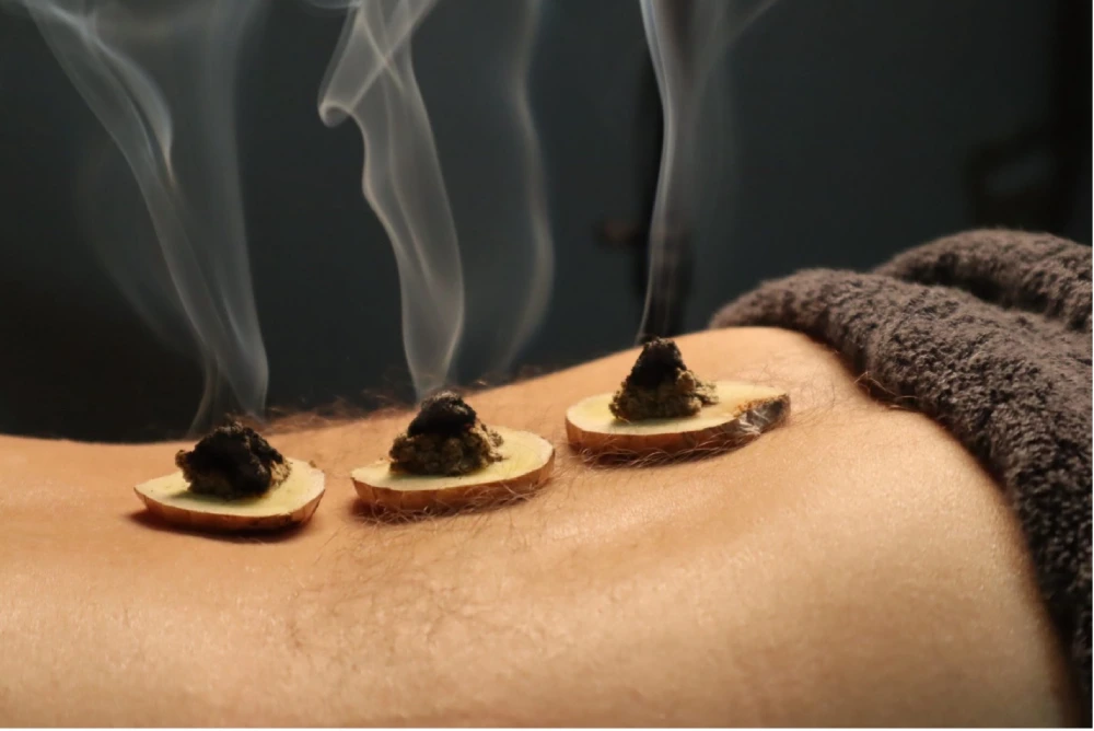 acupuncture and moxibustion