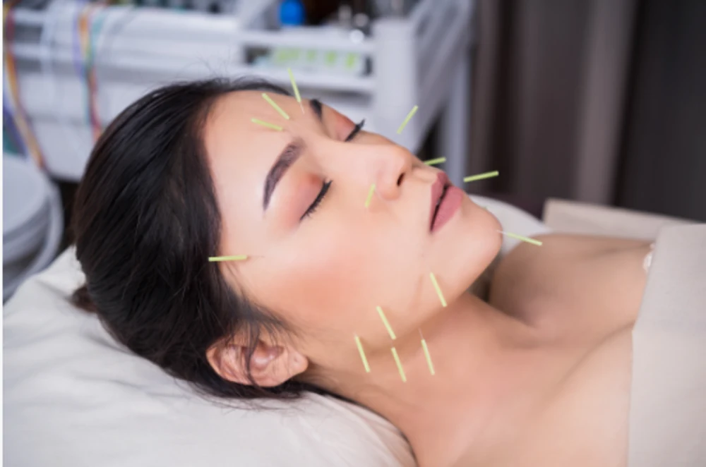 facial acupuncture benefits